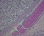 tumor-para-cada-foliculo-1