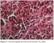 tumor-para-cada-foliculo-5