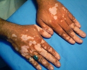 Vitiligo (3)