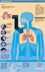 Tuberculose Ameaça a Saúde