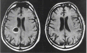Tumores Cerebrais
