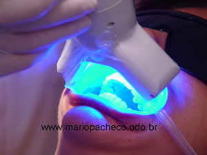 Clareamento Dental a Laser