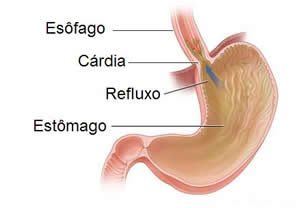 Refluxo