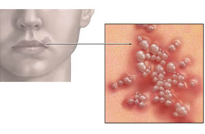 Herpes Oral