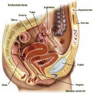 Endometriose