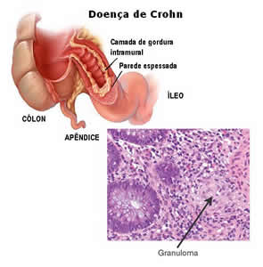 Síndrome de Crohn