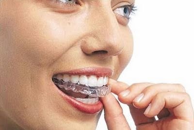 Moldeira Clareamento Dental