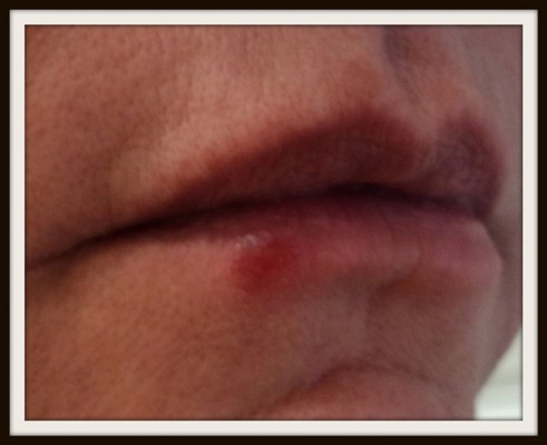 Herpes Labial