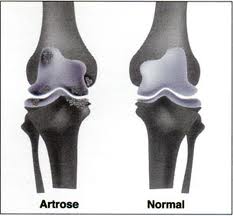 Artrose no Joelho