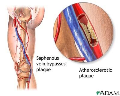 Doença Vascular Periférica