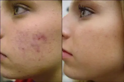 Como remover as cicatrizes de acne naturalmente