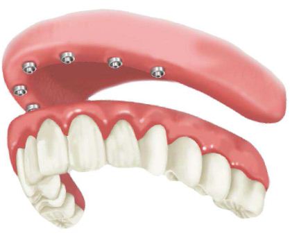 Mantenha a Dentadura Limpa para a Saúde