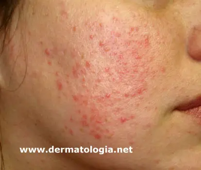 Acne Rosácea