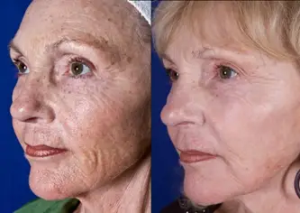 Antes e Depois do Peeling