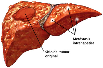 Câncer Hepático