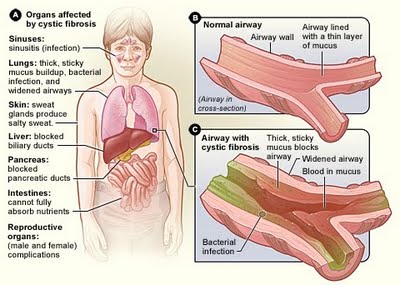 Fibrose Cística