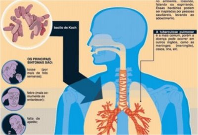 Tuberculose Prevenção