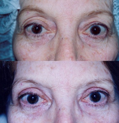 Blefaroplastia