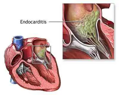 Endocardites