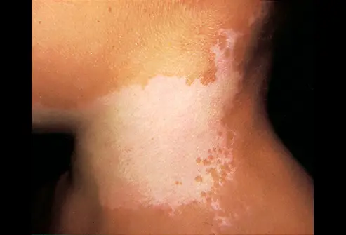 Causas do Vitiligo