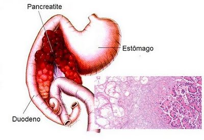 Pancreatite