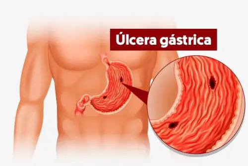 Úlceras Gástricas