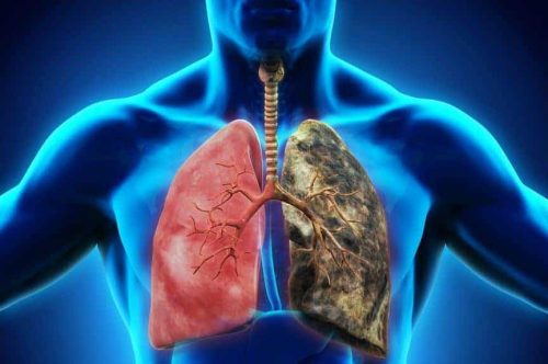 Doenças Pulmonares