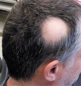 Alopecia Areata