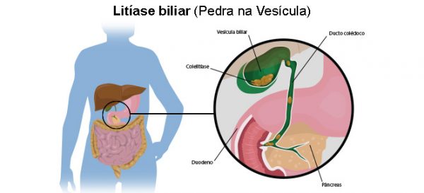 Pedra na Vesícula 